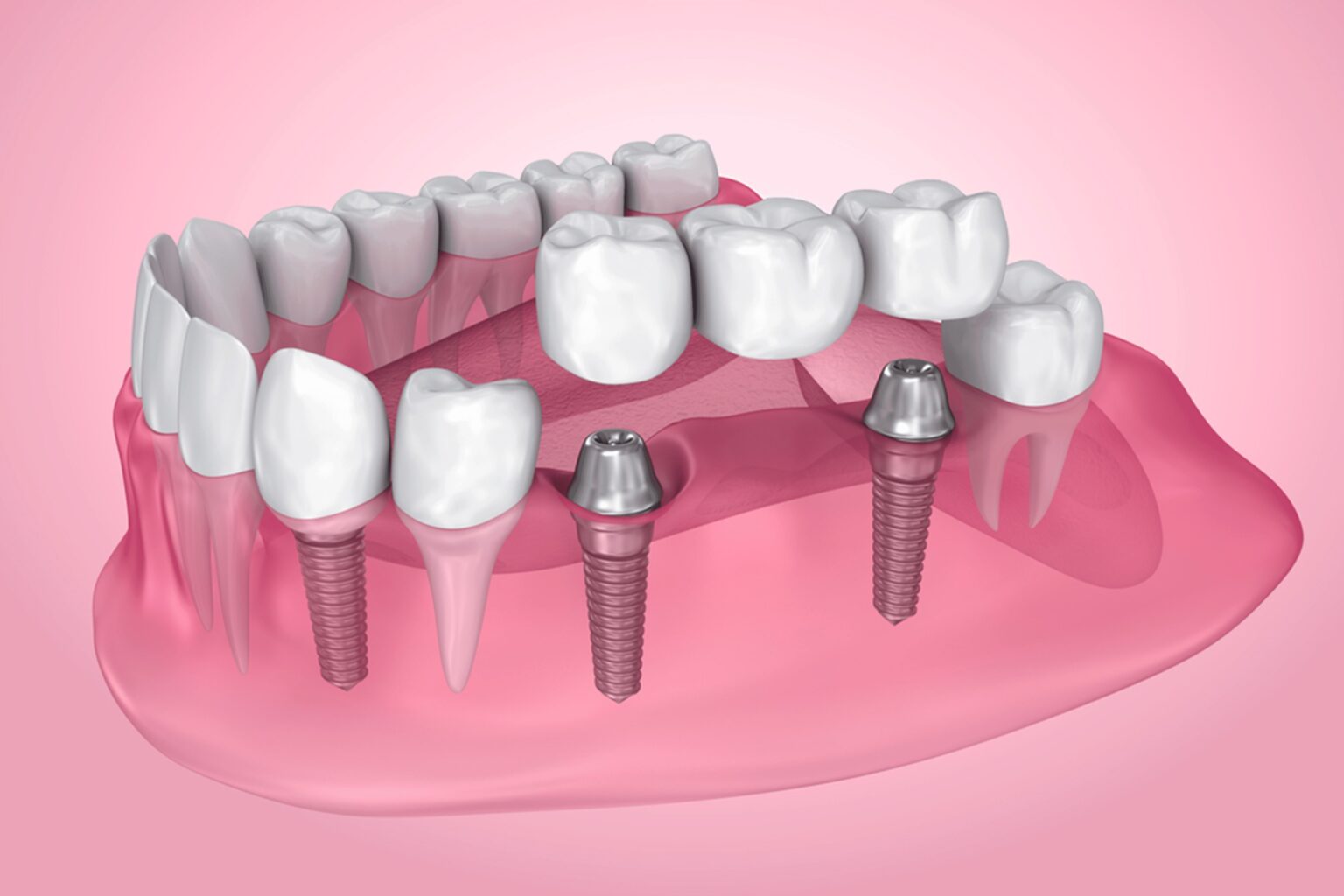 dental implants in edmonton near millwoods