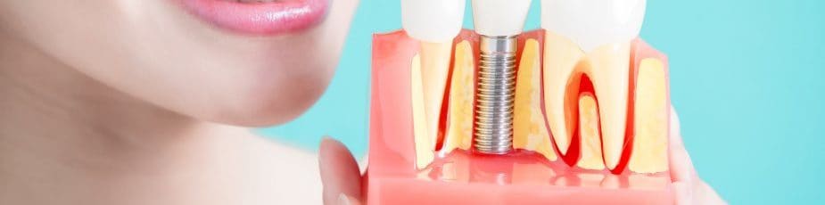 bridges implants or dentures for replacing missing teeth