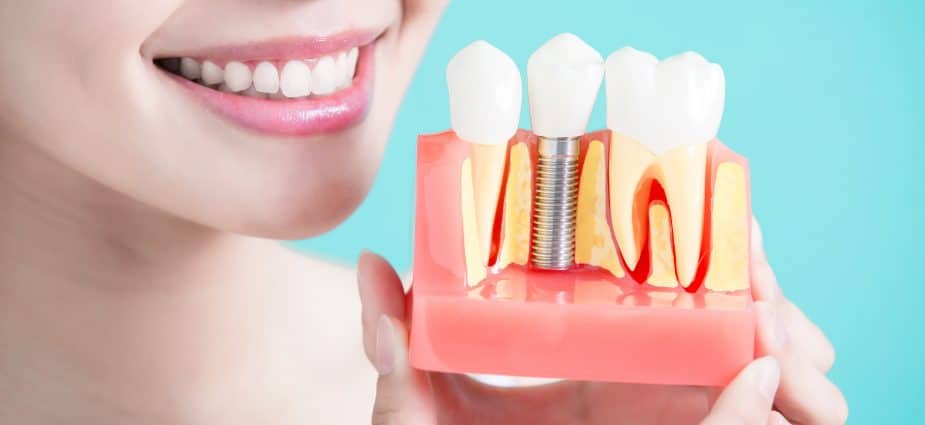 bridges, implants, or dentures for replacing missing teeth