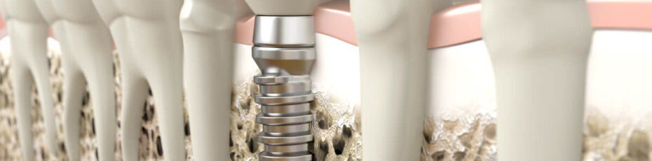 replace your missing teeth with dental implants