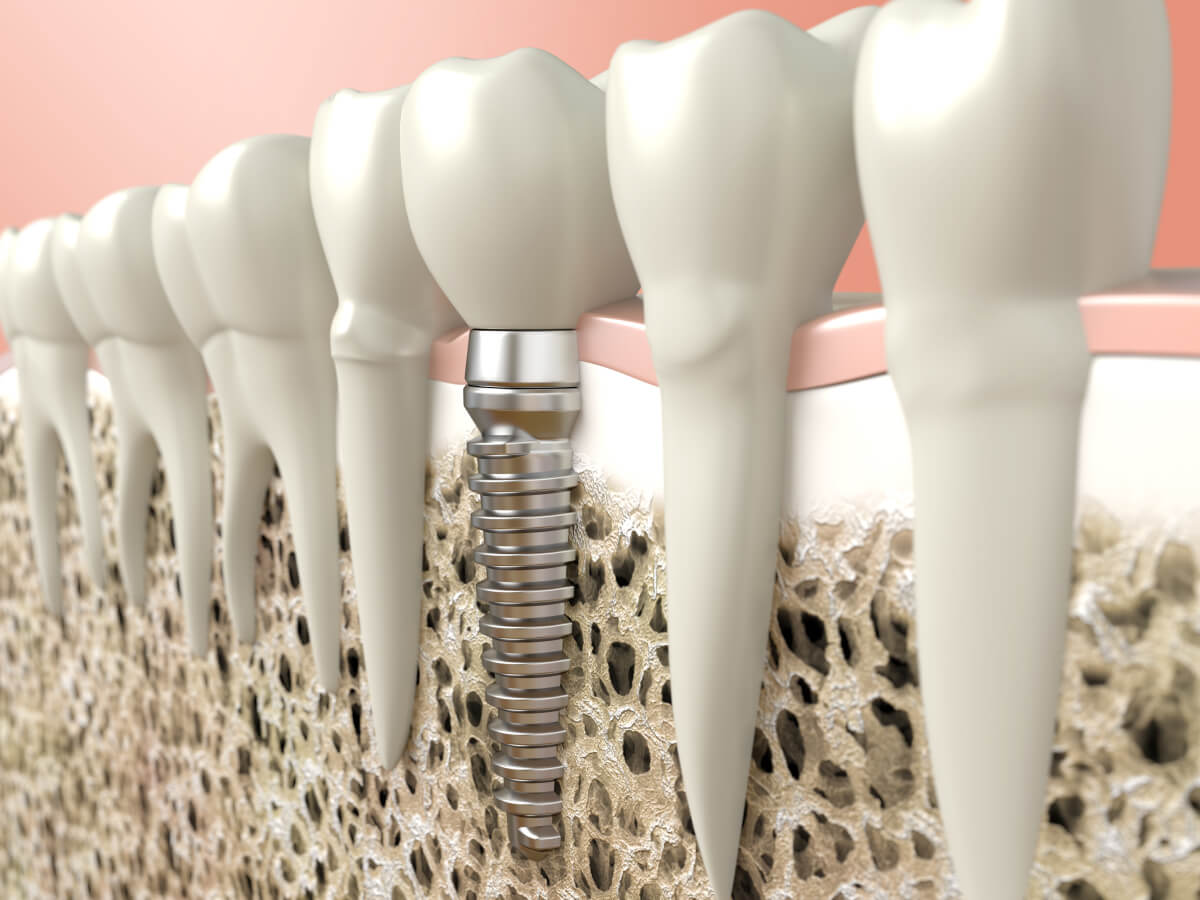replace your missing teeth with dental implants