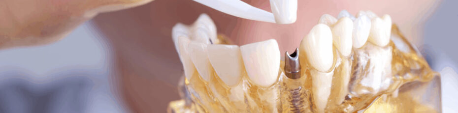 all about dental implants and infections