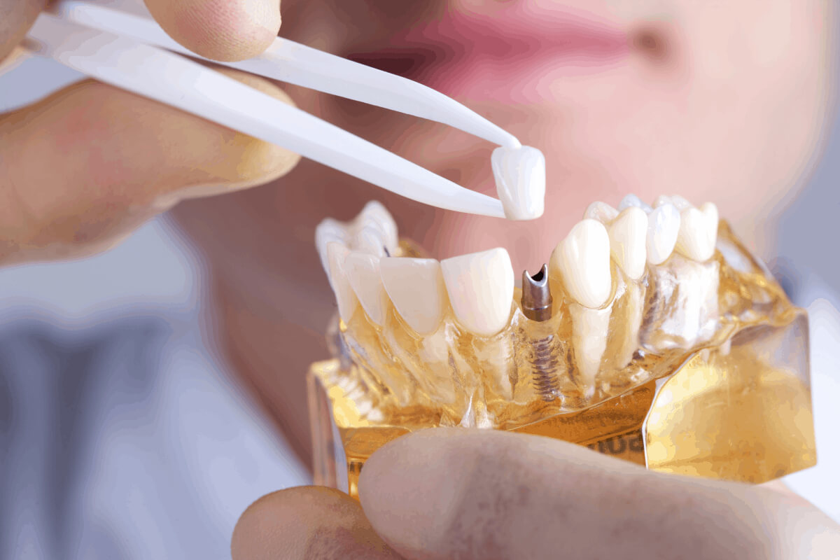 all about dental implants and infections