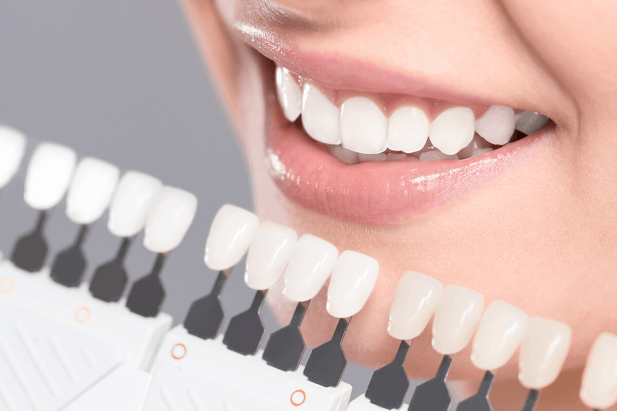 how to rebuild your smile with dental veneers
