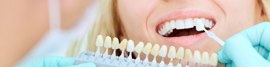 what to expect when getting porcelain veneers