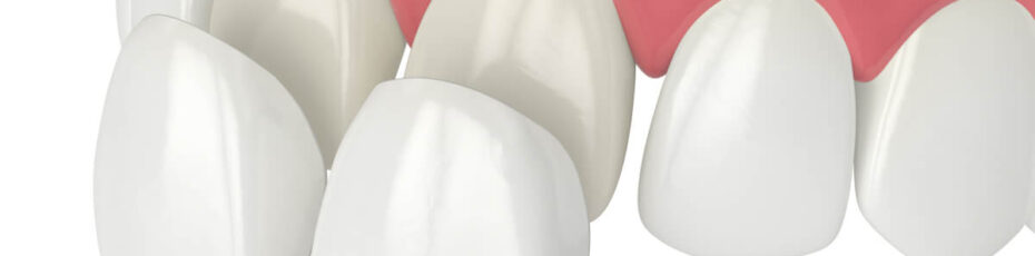 porcelain veneers your key to a stunning smile makeover