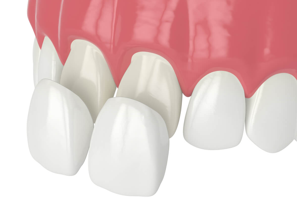 porcelain veneers: your key to a stunning smile makeover