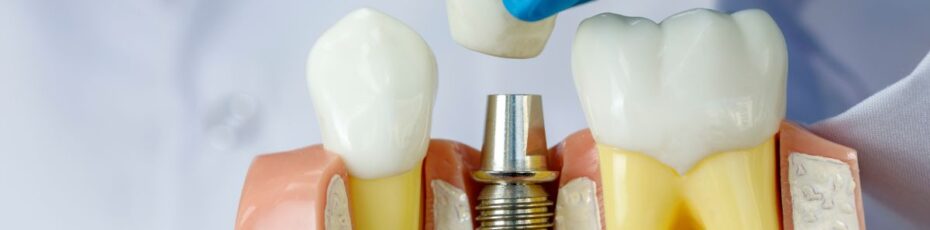 5 facts you need to know about dental implants