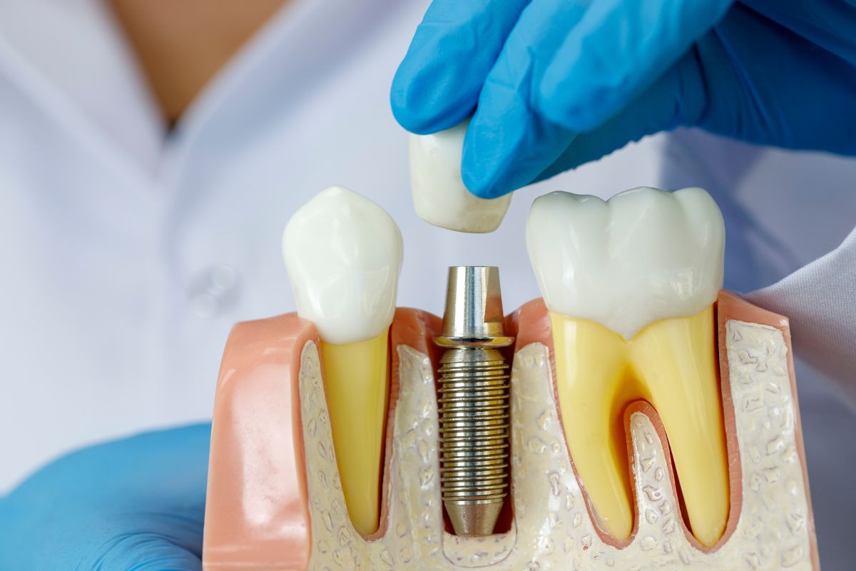 5 facts you need to know about dental implants