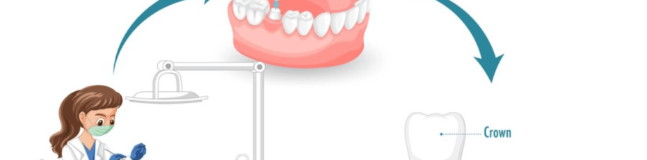 when to get dental crowns a comprehensive guide