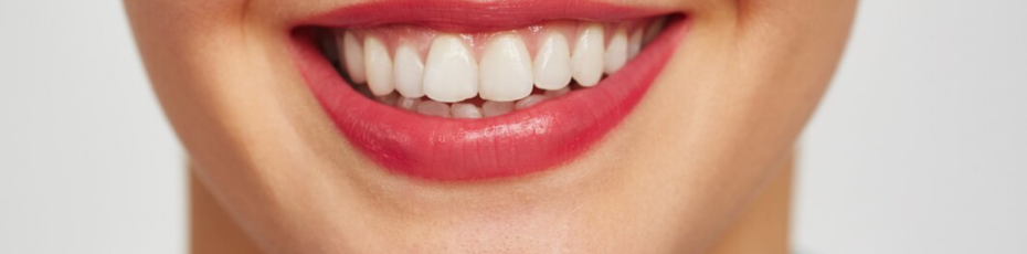 teeth whitening vs veneers: which option is best for your smile