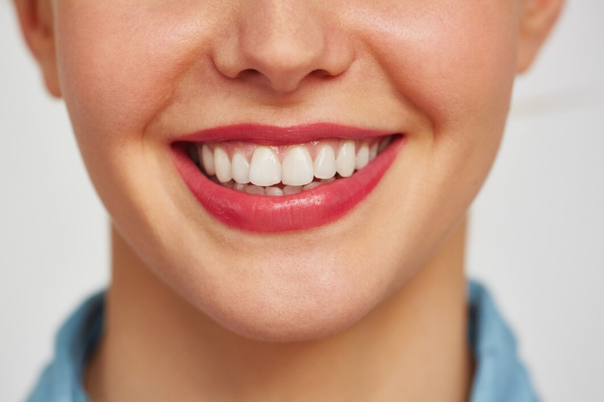 teeth whitening vs veneers: which option is best for your smile