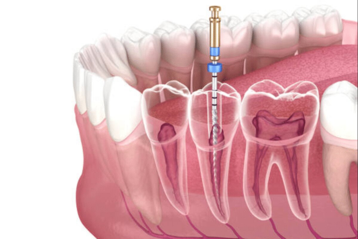 tips for fast recovery after root canal procedure