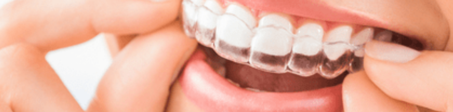 invisalign clear aligners