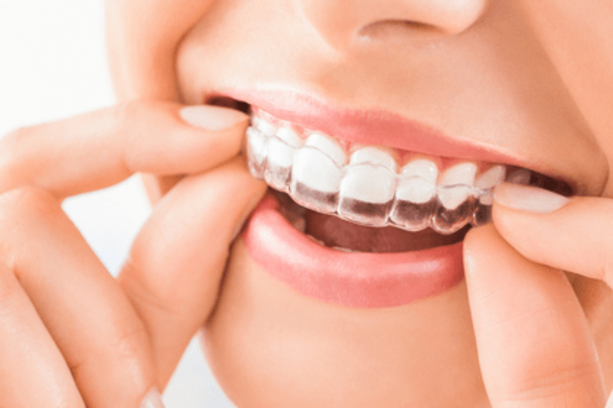 invisalign clear aligners