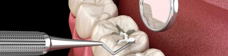 best age to get dental sealants for your kid