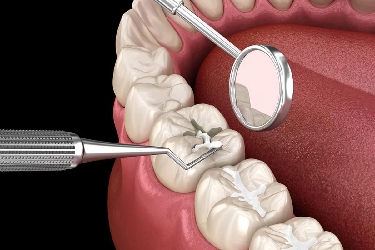 best age to get dental sealants for your kid
