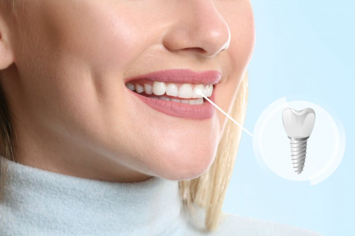tooth replacement after dental implants