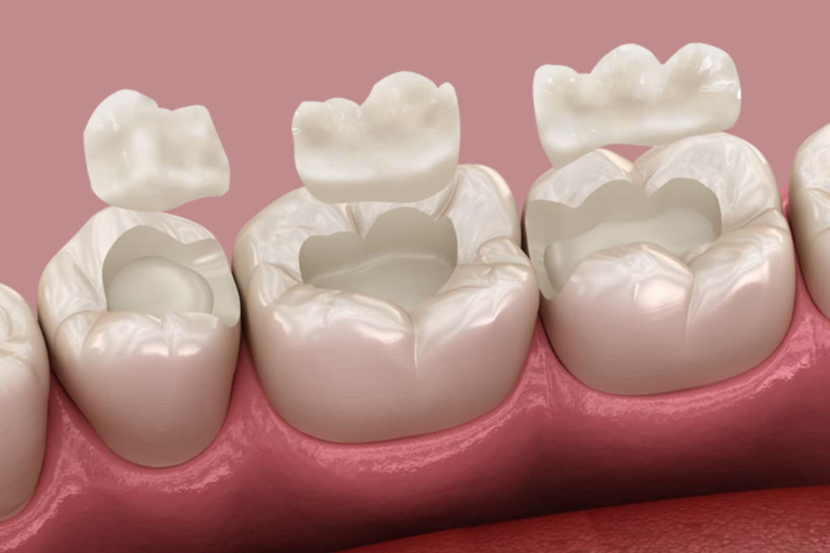 material used for dental inlay vs onlay