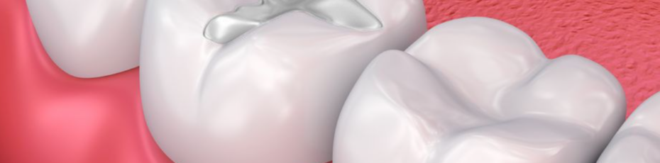 tooth coloured fillings benefits
