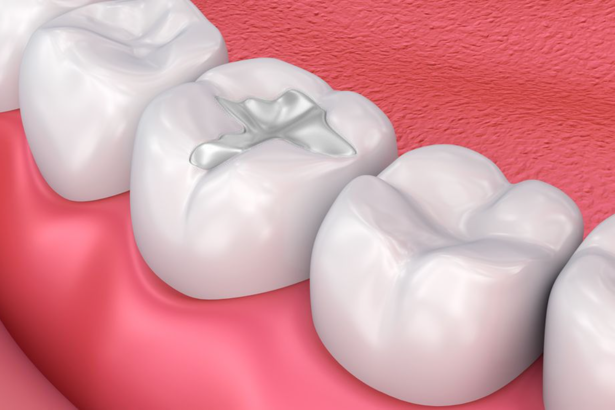 tooth coloured fillings benefits