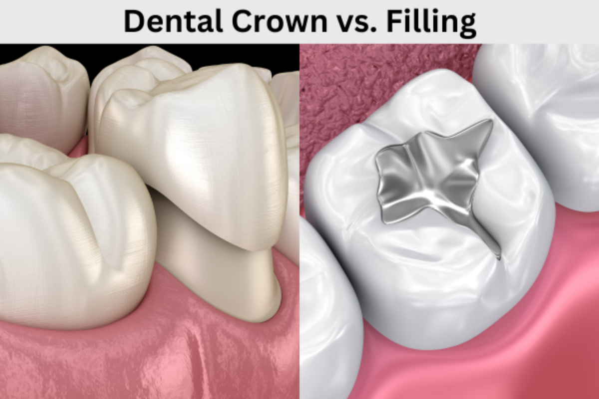 dental crown vs fillings