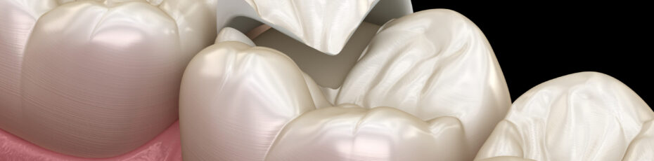 dental inlay onlay