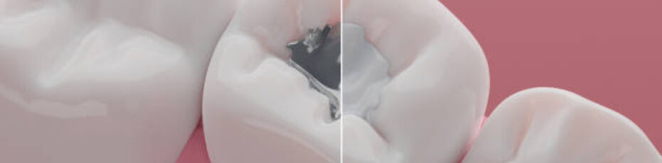 metal-to-colored-dental-fillings