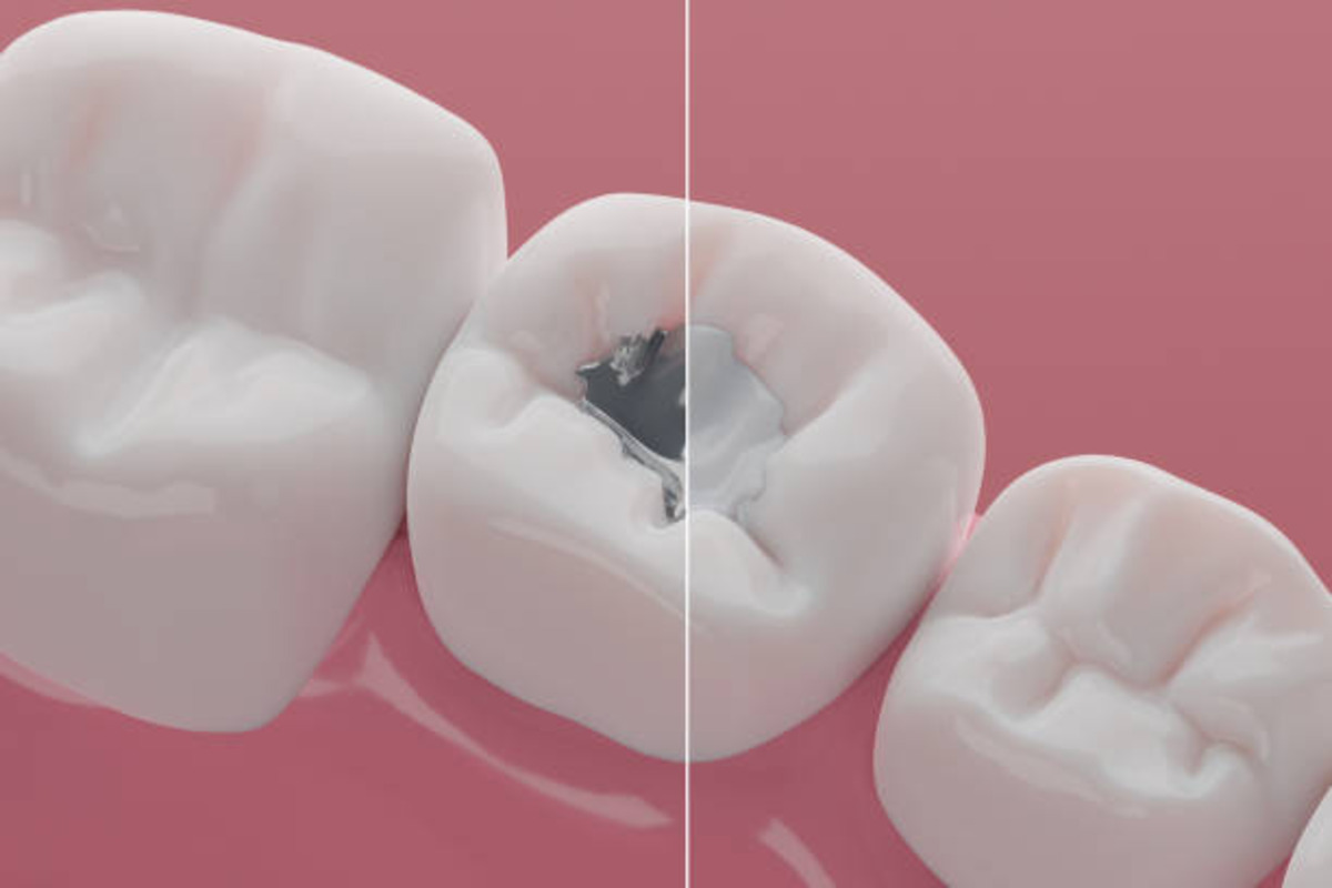 metal-to-colored-dental-fillings