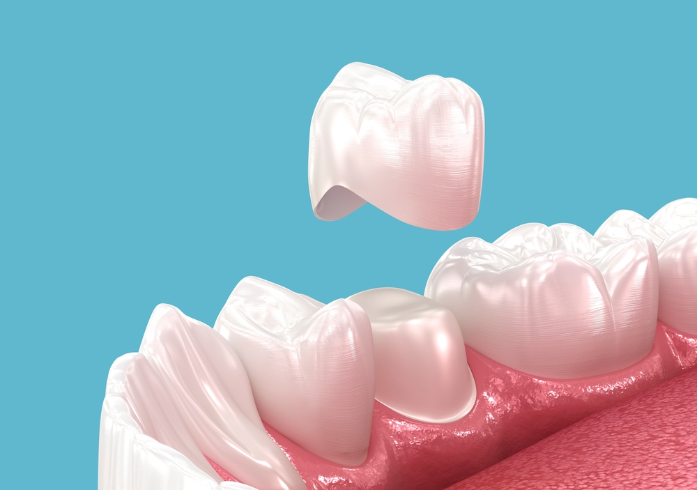 How Crowns Improve the Strength and Appearance of Damaged Teeth