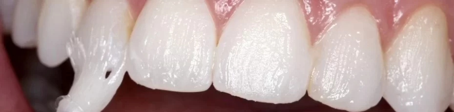 what is a fluoride treatment, how does it help teeth, and what is its cost