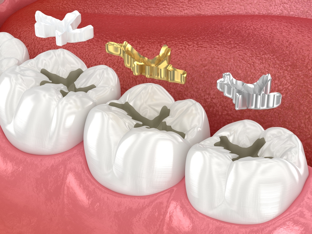 composite fillings vs. silver fillings what’s better