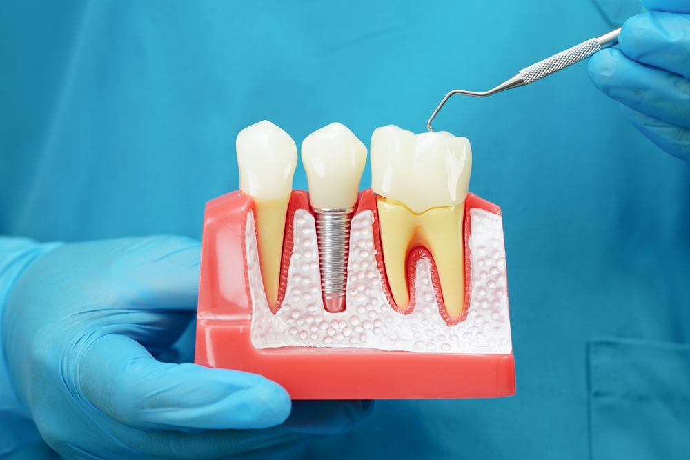what are the different types of dental implants, and are implants safe and permanent