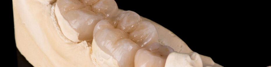 inlay vs onlay what’s the difference and are they better than fillings