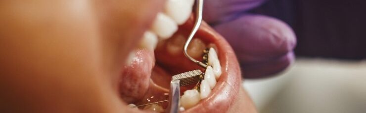 How inlays preserve more of your natural tooth