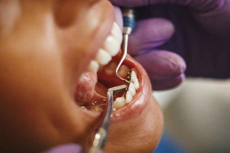 How inlays preserve more of your natural tooth