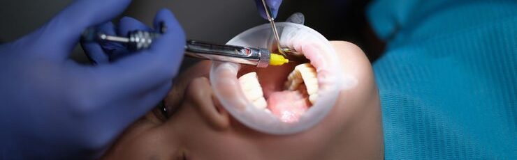 How dental inlays treat deep cavities safely