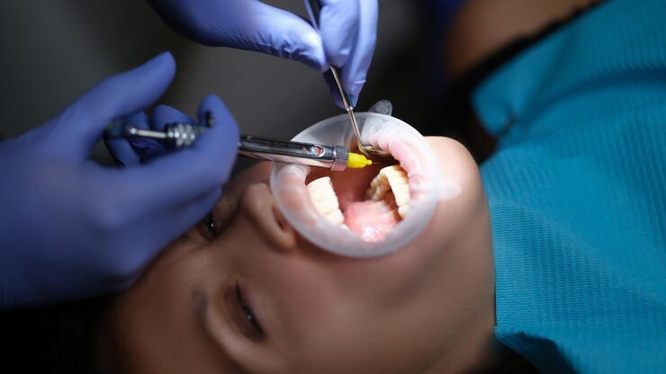 How dental inlays treat deep cavities safely